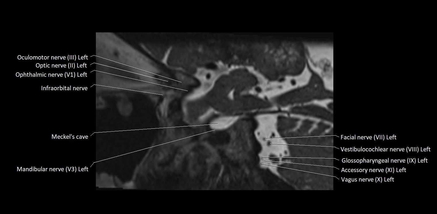 Cranial nerve sagittal anatomy MRI 3T image 17.webp